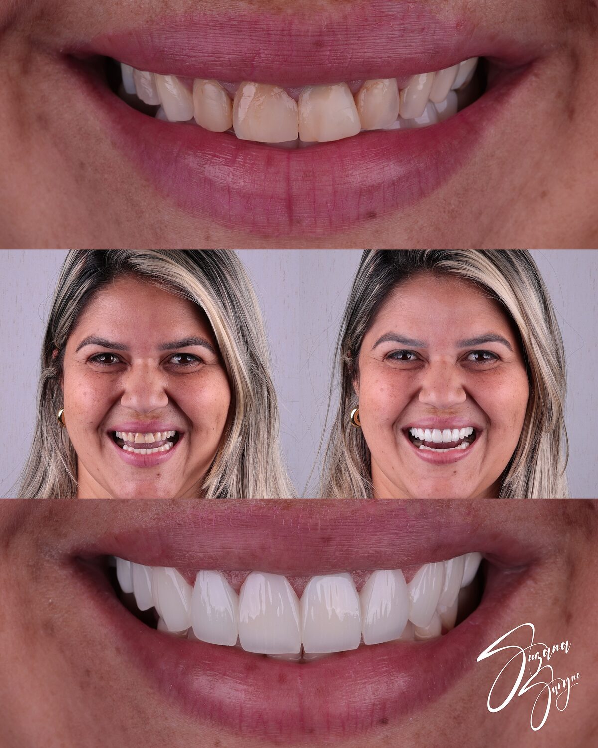 Caso 1 · harmonização e clareamento do sorriso — foto 1