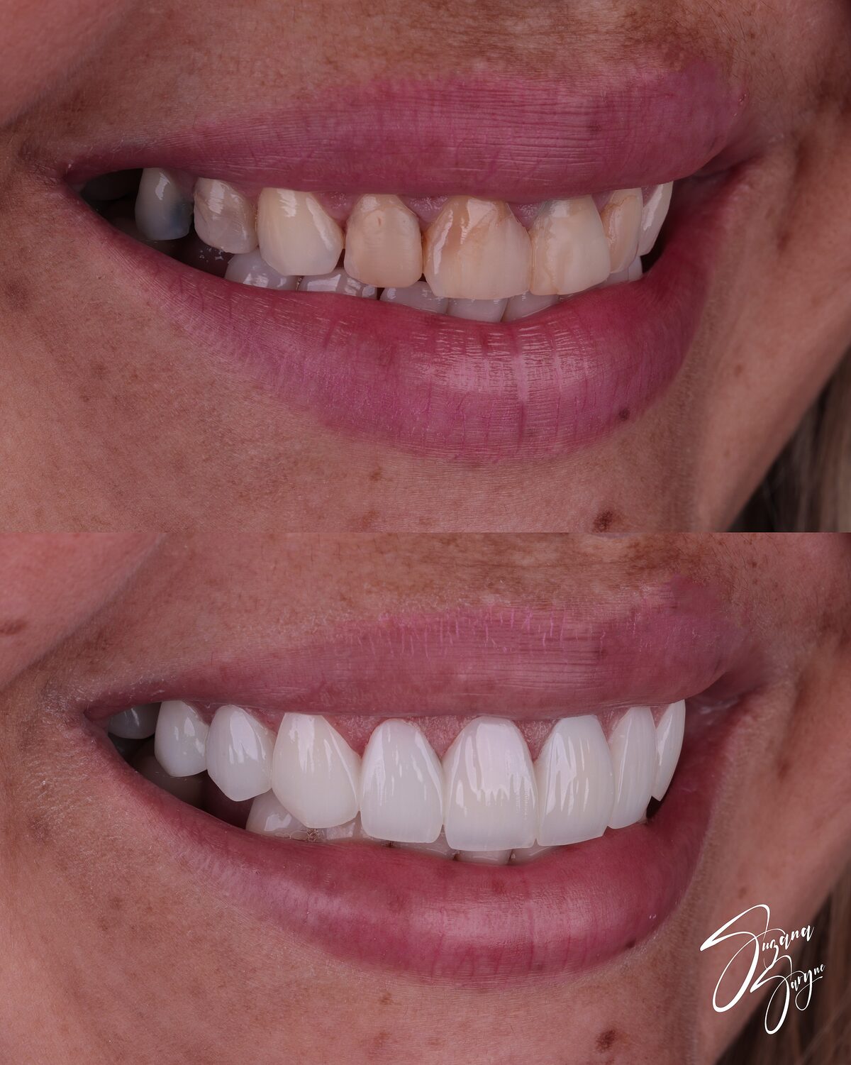 Caso 1 · harmonização e clareamento do sorriso — foto 2