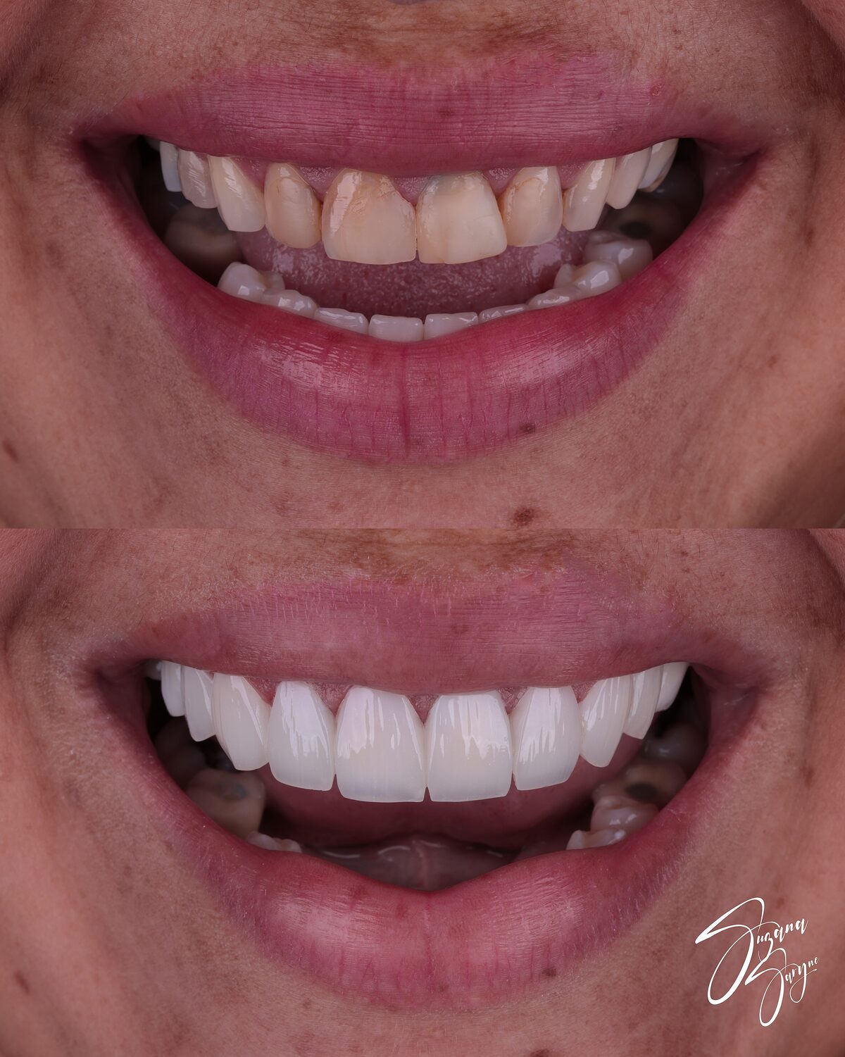 Caso 1 · harmonização e clareamento do sorriso — foto 3