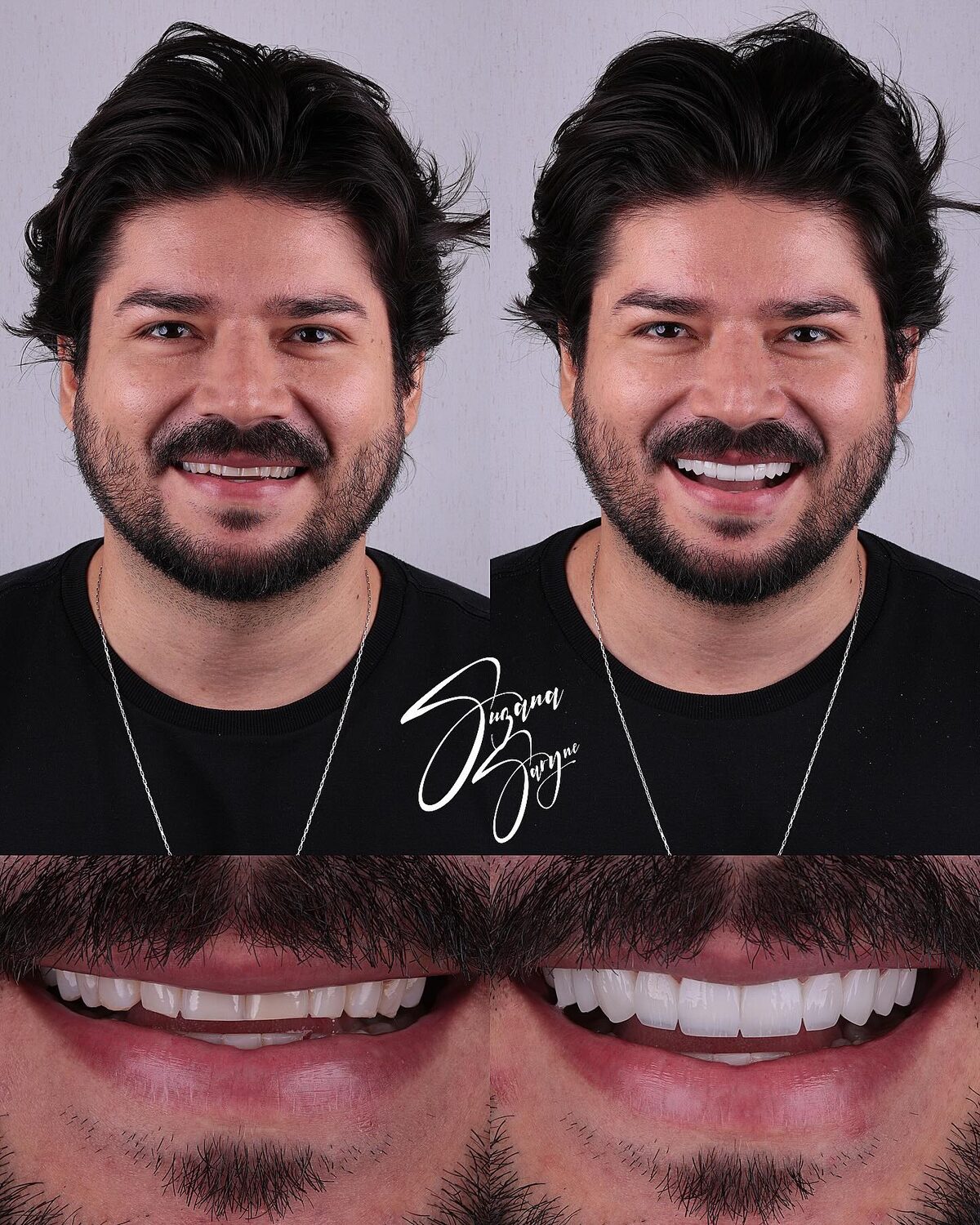 Caso 2 · reanatomização e alinhamento do sorriso — foto 1