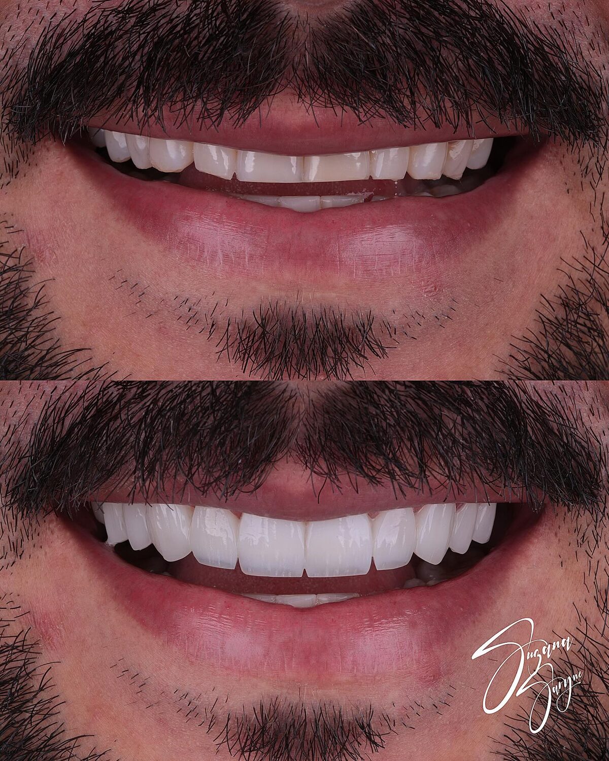 Caso 2 · reanatomização e alinhamento do sorriso — foto 2