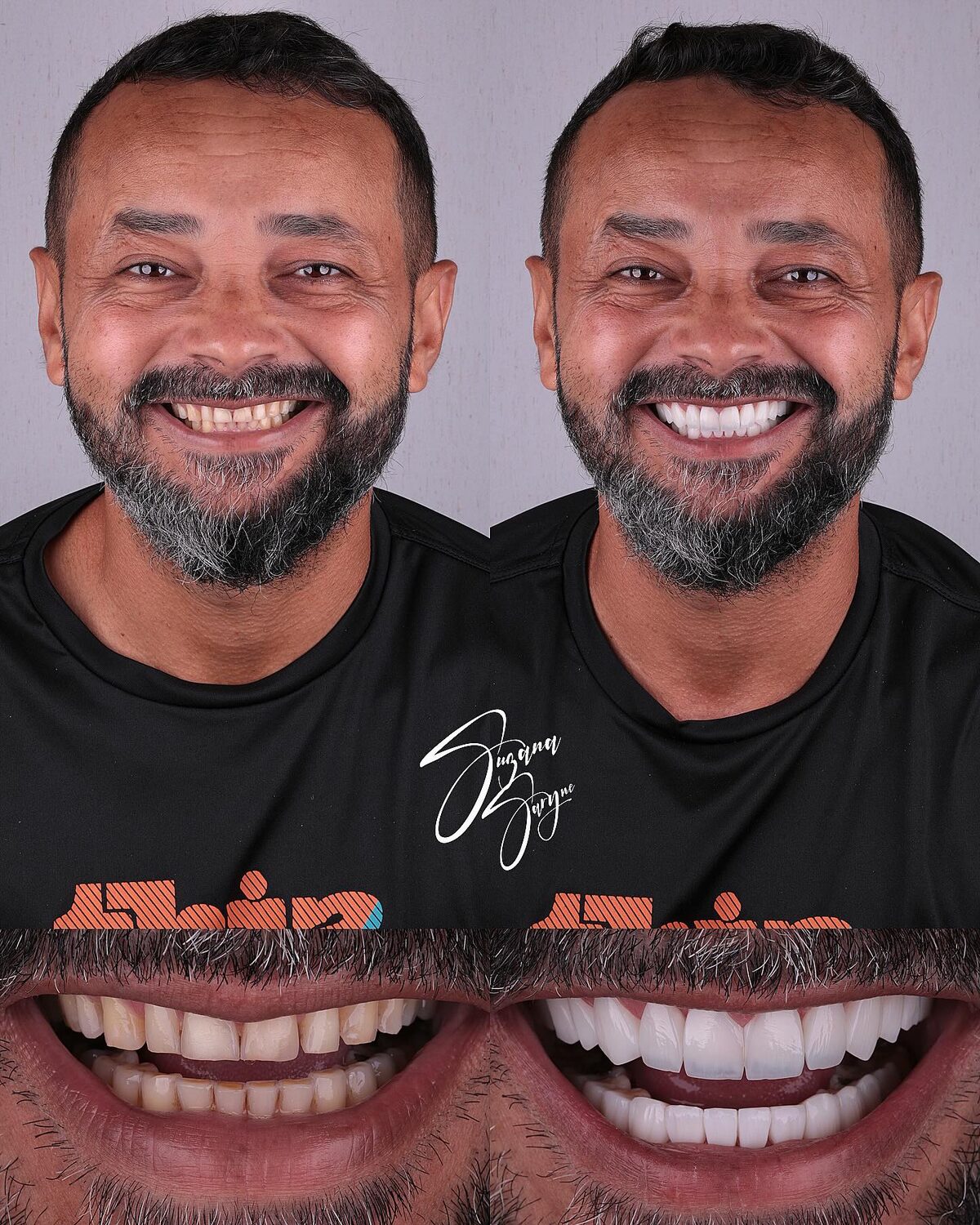 Caso 4 · renovação completa do sorriso — foto 1