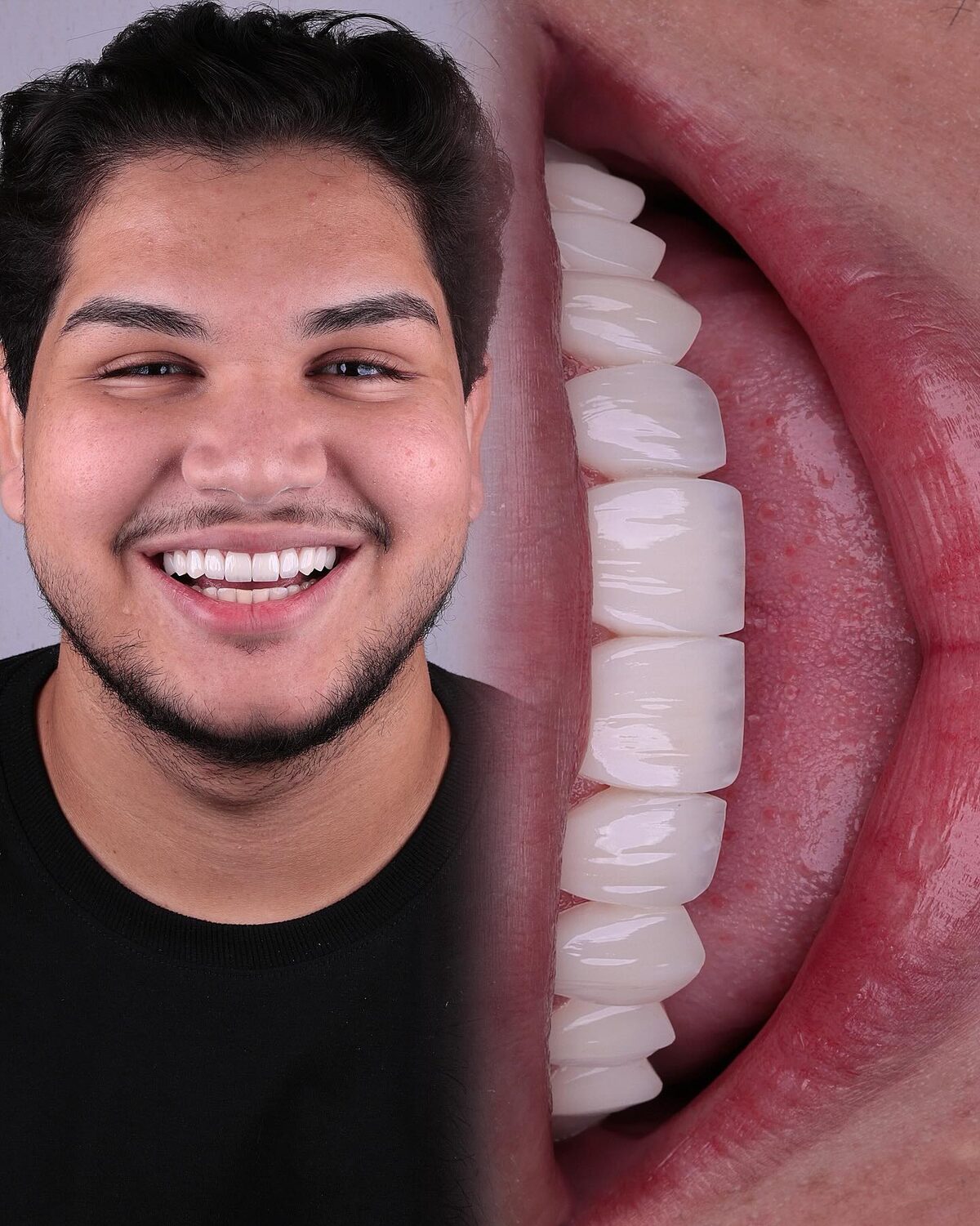 Caso 5 · desenho do sorriso com naturalidade — foto 1