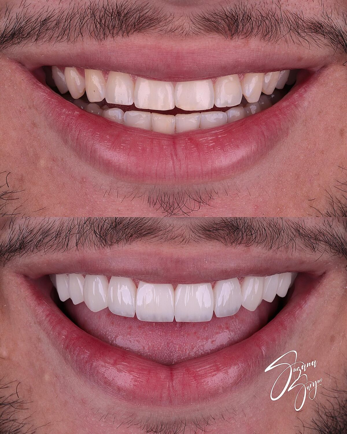 Caso 5 · desenho do sorriso com naturalidade — foto 2