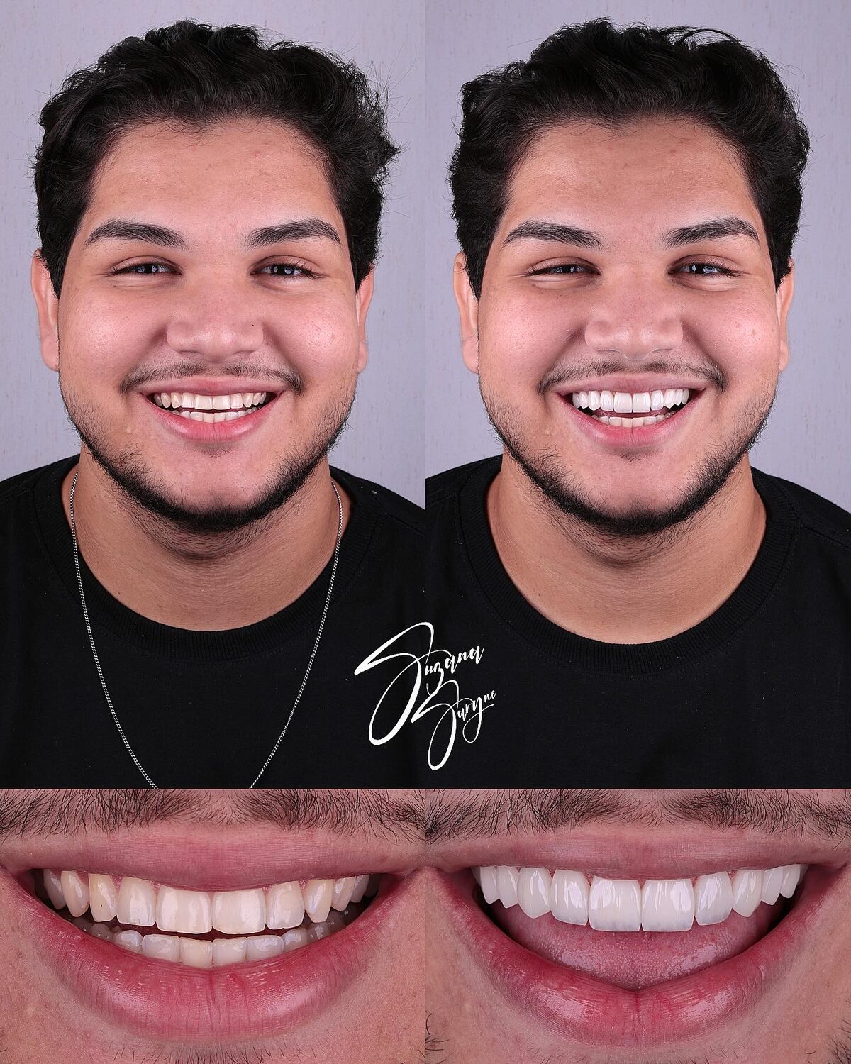 Caso 5 · desenho do sorriso com naturalidade — foto 3
