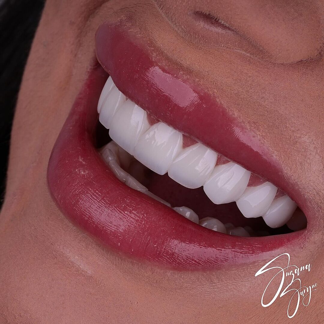 Close de um sorriso finalizado com lentes em resina
